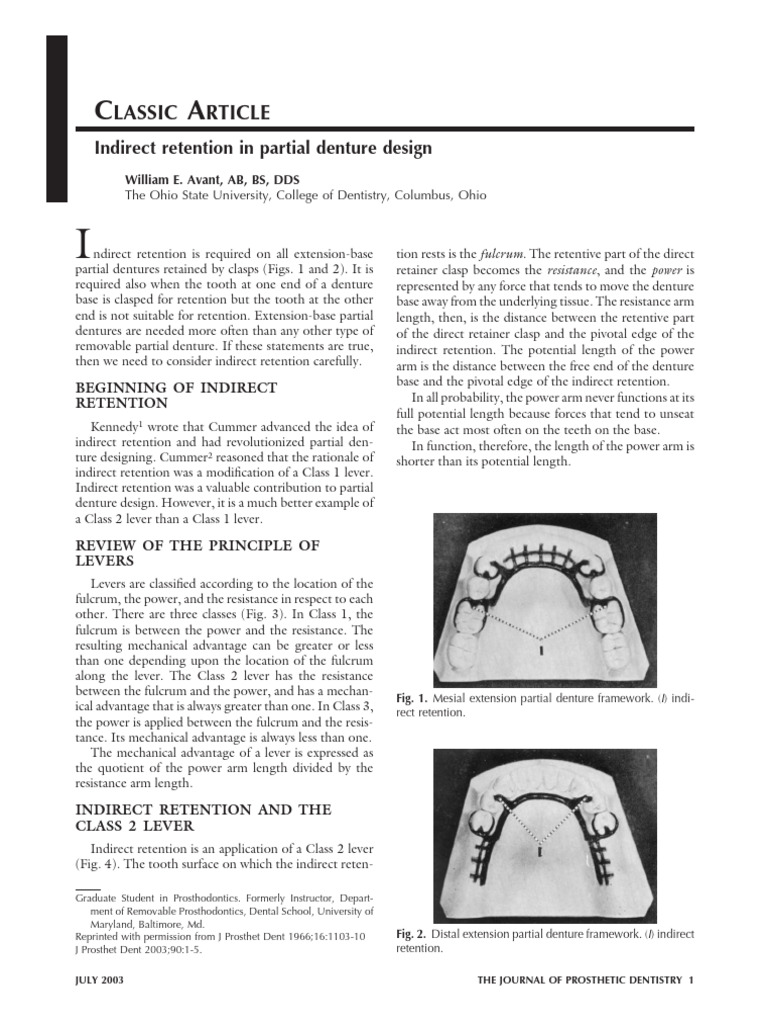Indirect Retention in Dentures | PDF | Dentures | Lever