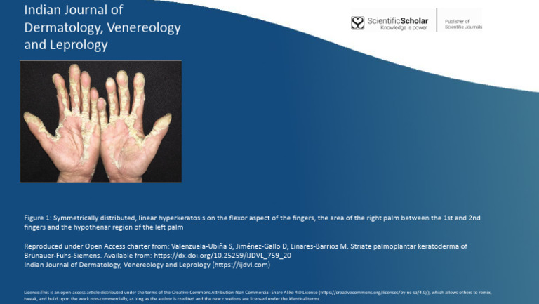 Indian Journal of Dermatology, Venereology and Leprology | PDF