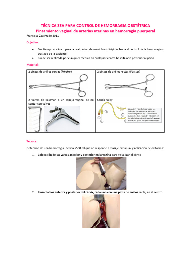 Técnica Zea para Control de Hemorragia Obstétrica | PDF ...