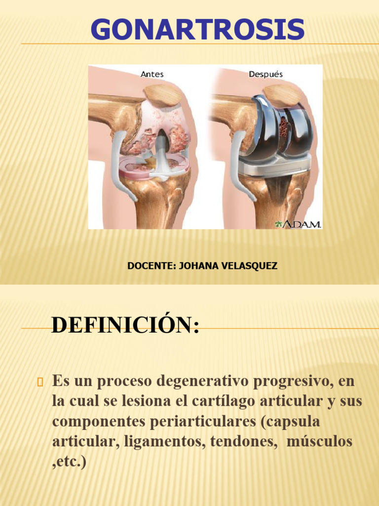 Tratamientos para la Gonartrosis | PDF | Articulación | Rodilla