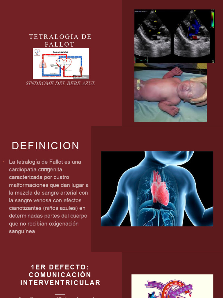 Tetralogía de Fallot: Síntomas y Tratamiento | PDF | Corazón | Defecto ...