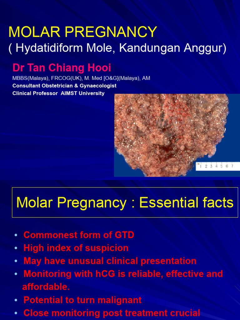 。18. Molar Pregnancy | PDF | Mammalian Pregnancy | Neoplasms