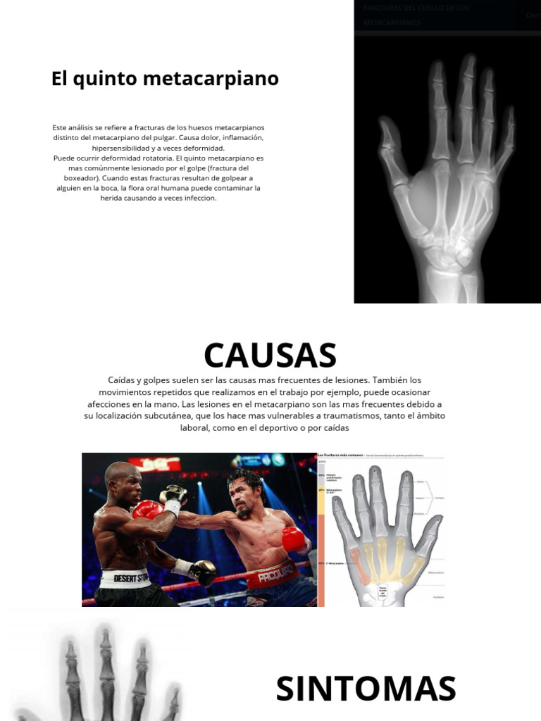Fractura del Quinto Metacarpiano: Síntomas y Tratamiento | PDF | Mano ...