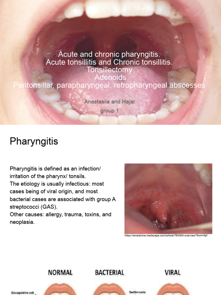 Topic 5 - Acute and Chronic Pharyngitis | PDF | Lymphatic System ...