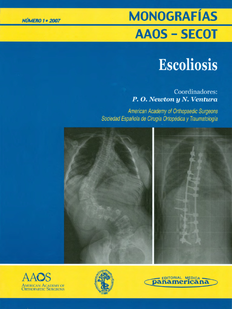 AAOS Escoliosis Comp | PDF | Escoliosis | Tórax