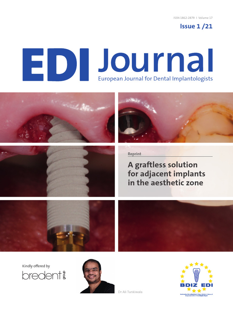 Graftless Adjacent Implants Solution | PDF | Dental Implant | Dentistry