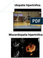 Miocardiopatía hipertrófica