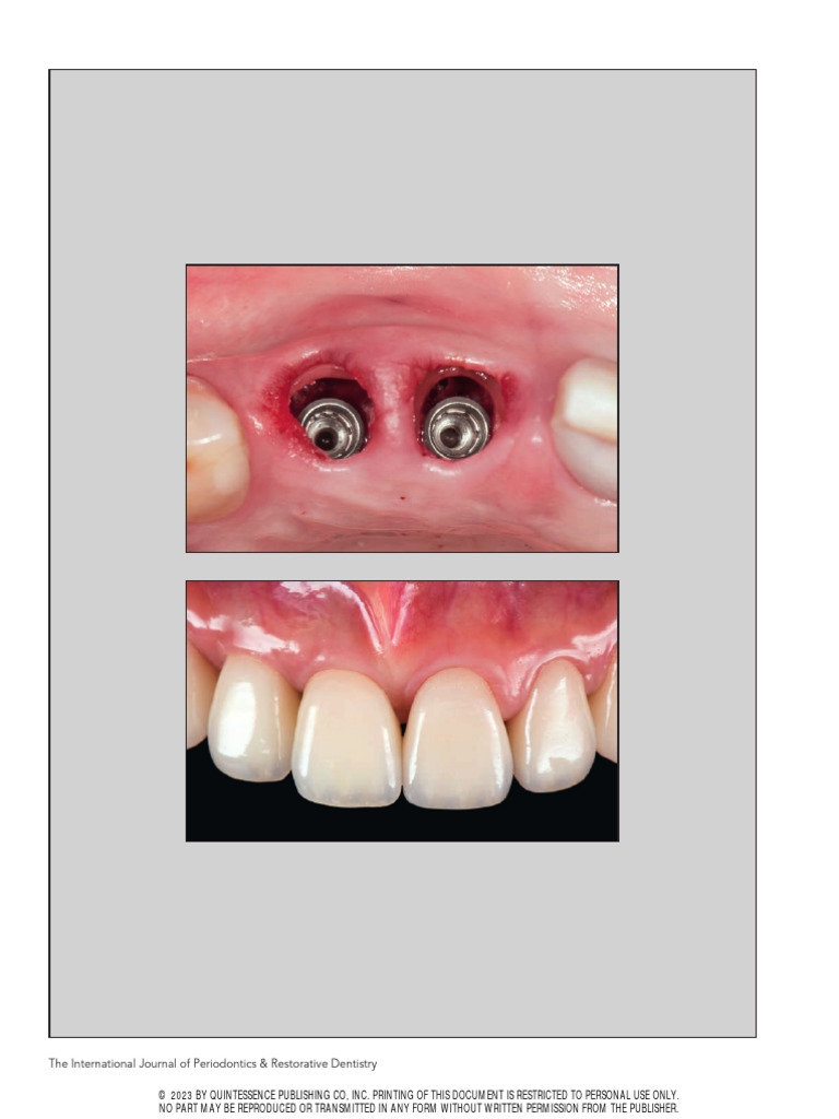 Chen IJPRD23 | PDF | Dental Implant | Periodontology