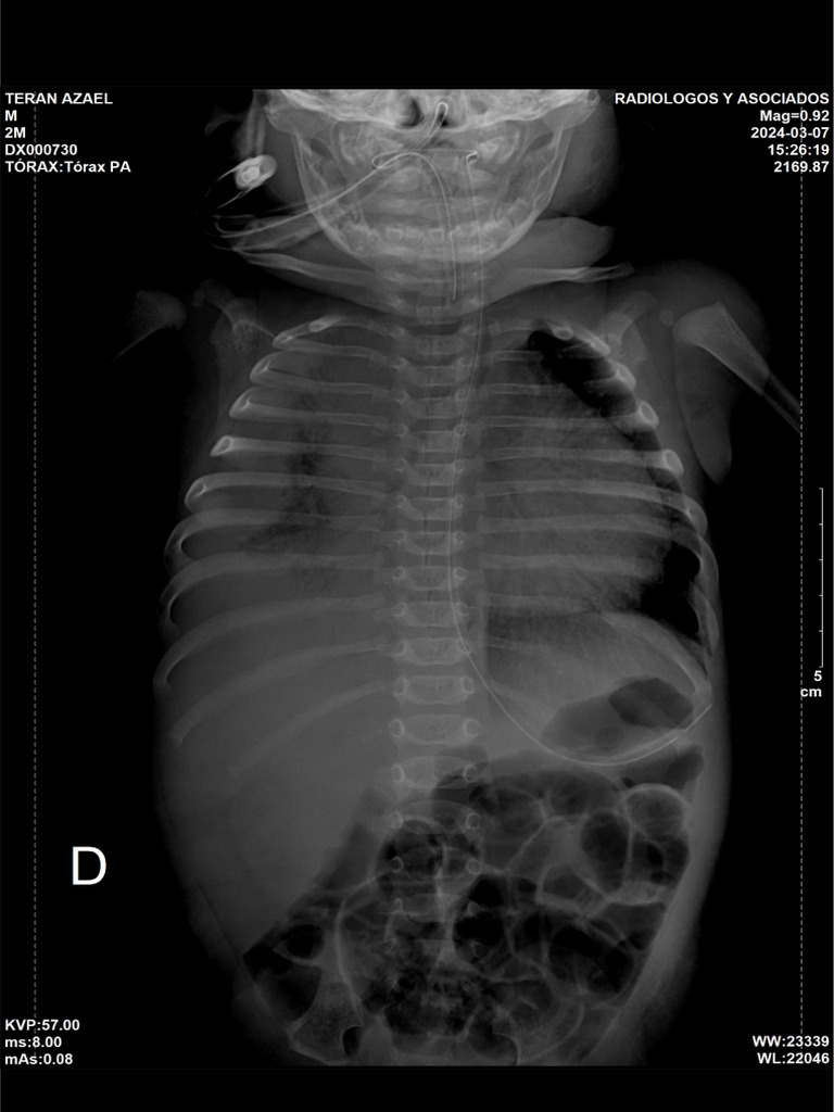 Teran Azael 2 Meses RX Torax Ap Acostado | PDF