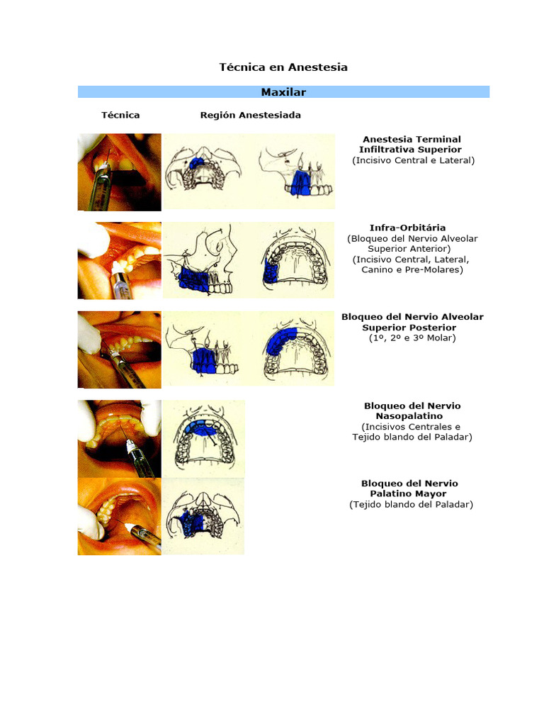 Técnicas de Anestesia Dental Maxilar y Mandibular | PDF