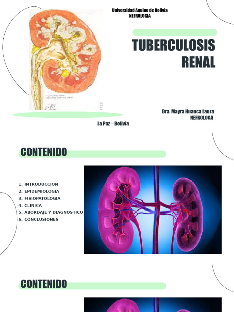 Tuberculosis Renal 1 | PDF | Tuberculosis | Riñón