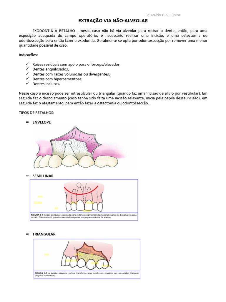 Exodontia Via Não Alveolar | PDF | Dente humano