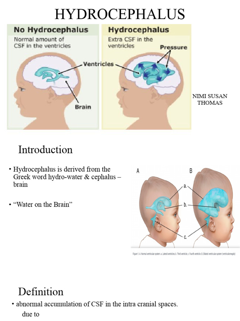 HYDROCEPHALUS | Download Free PDF | Cerebrospinal Fluid | Medical ...