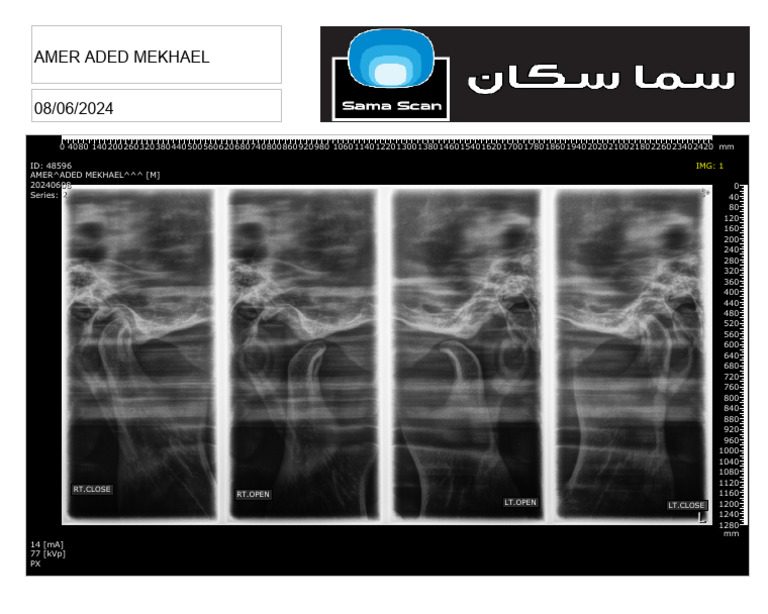 Amer Aded Mekhael - TMJ | PDF