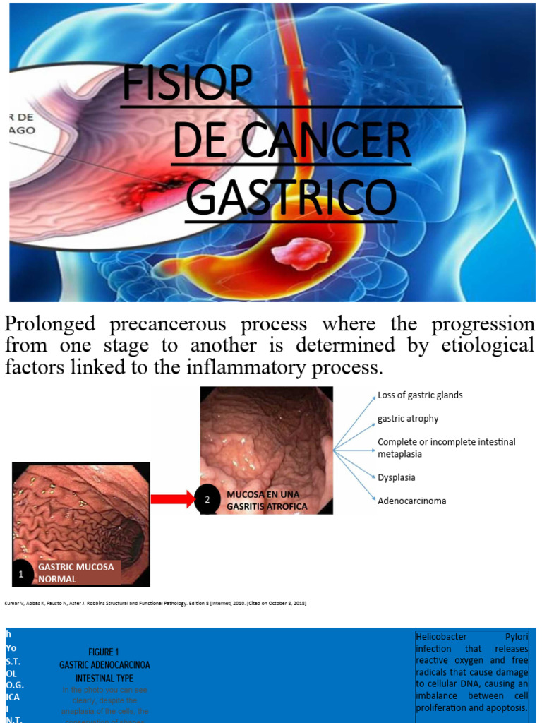 Pathophysiology Of Gastric Cancer PDF Cancer Adenocarcinoma