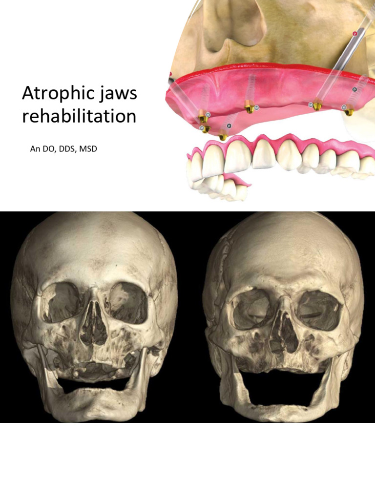 Fresh Look at Atrophic Jaw Implant Guide Pdf Dental Implant