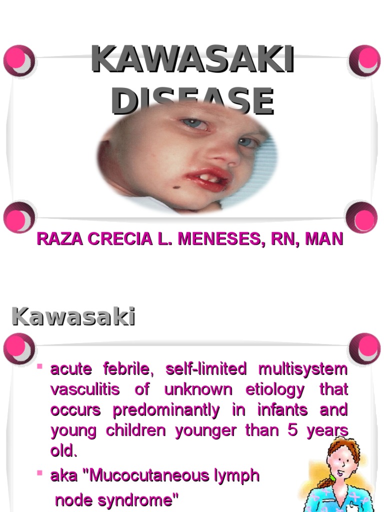 Kawasaki PDF Aspirin Medical Specialties