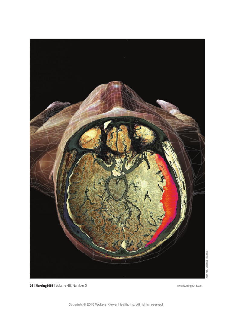 Chronic Subdural Hematoma - A Common Complexity | PDF | Medical ...
