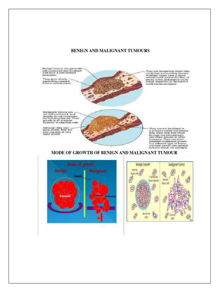 Benign vs Malignant Tumours Analysis | PDF | Neoplasms | Benign Tumor