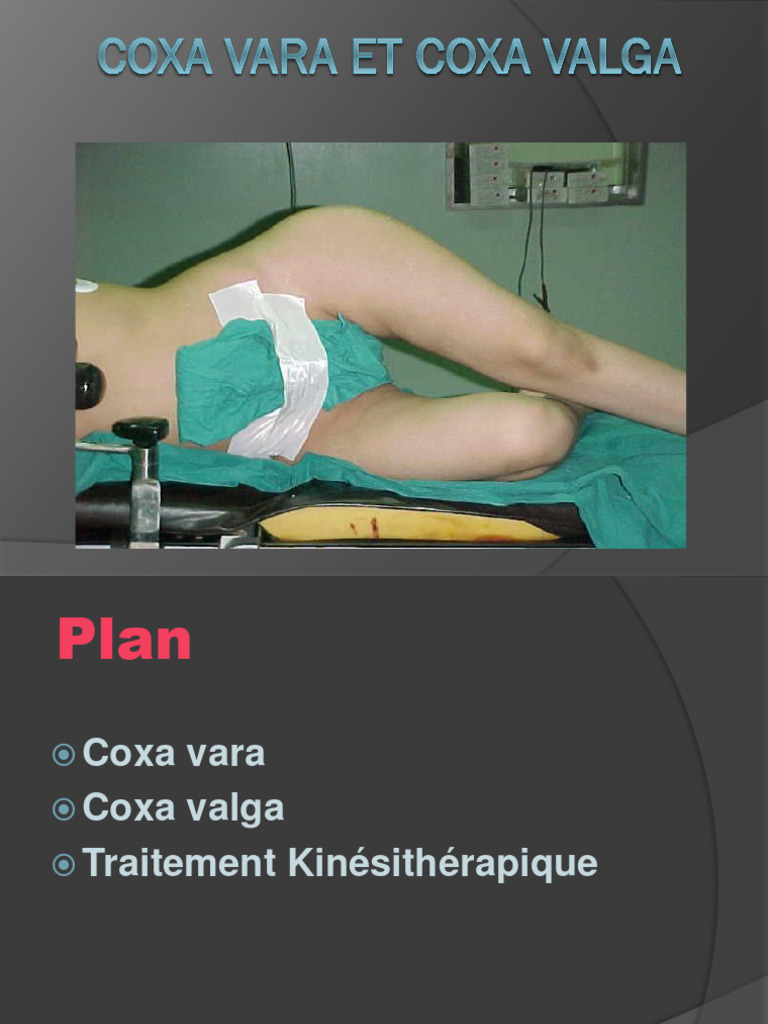 Coxa Vara et Coxa Valga : Définitions et Traitements | PDF | Bien-être