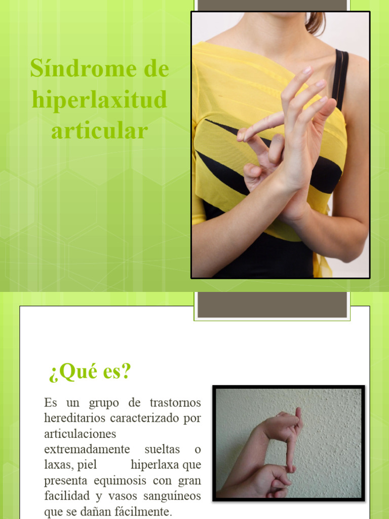 Guía del Síndrome de Hiperlaxitud | PDF | Medicina | Causas de la muerte
