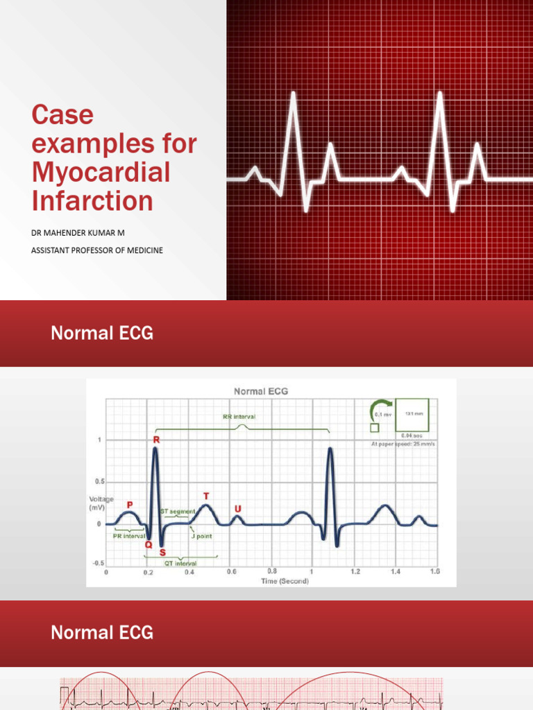Case Examples For Myocardial Infarction | PDF | Myocardial Infarction ...