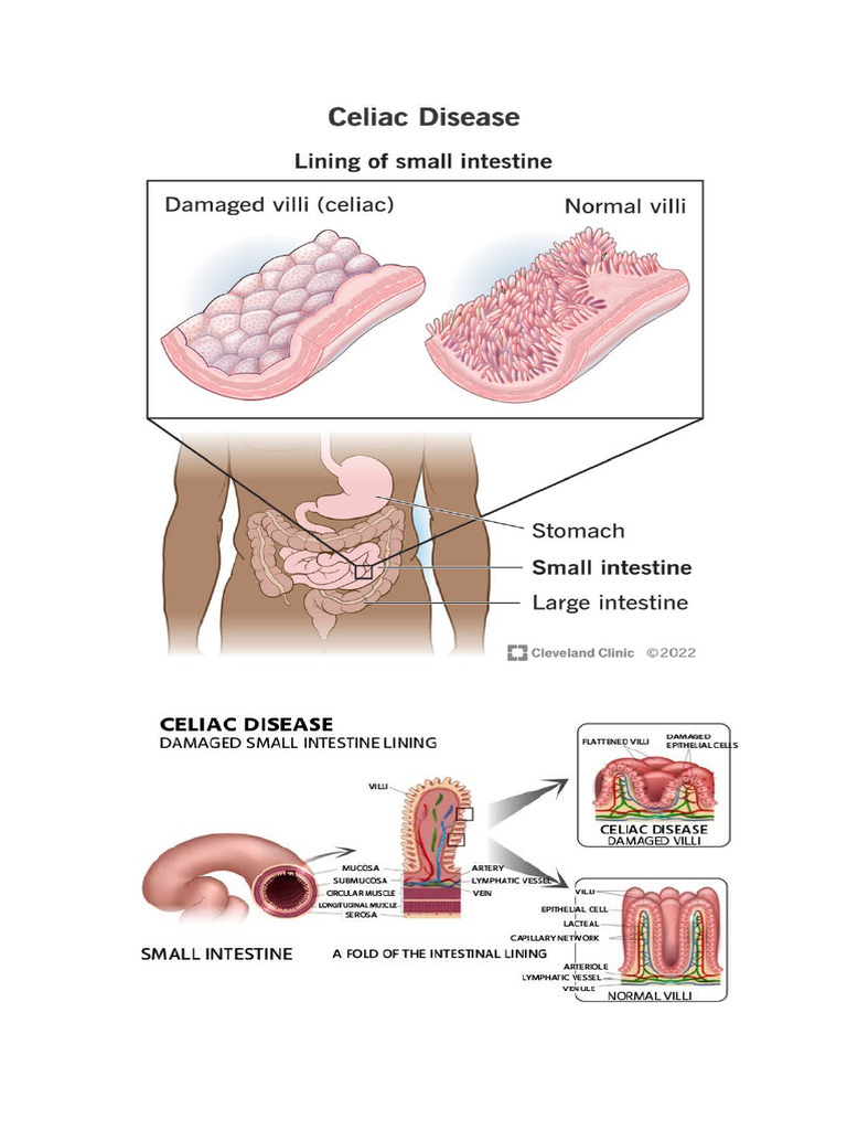 Celiac Disease | PDF