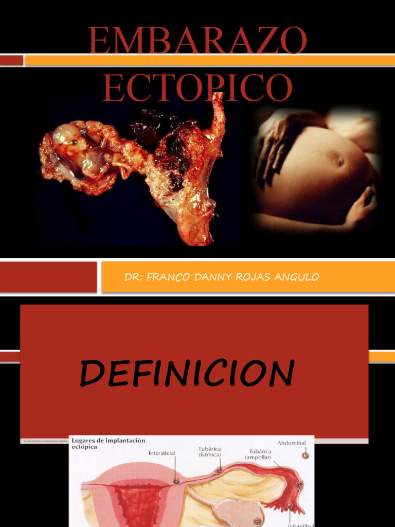 29 EMBARAZO ECTOPICO | PDF | El embarazo | Reproducción humana