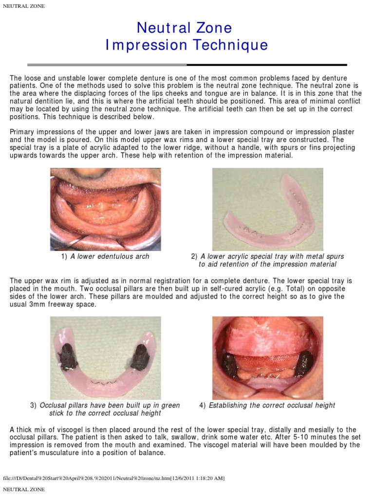Neutral Zone Technique for Complete Dentures | PDF | Dentures | Mouth
