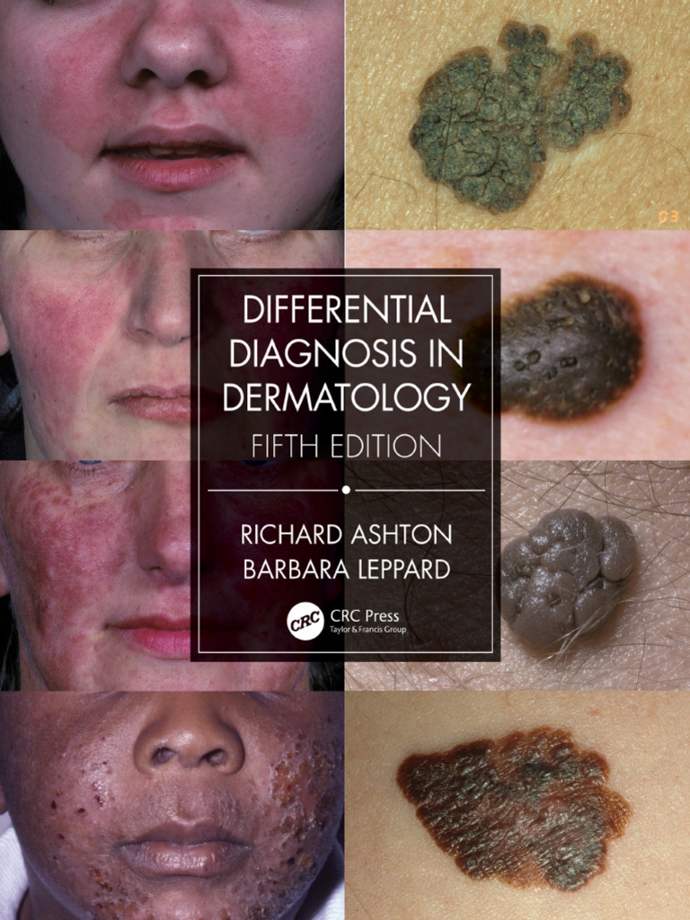 Preview-9780429665585 A40306585 | PDF | Dermatitis | Topical Medication