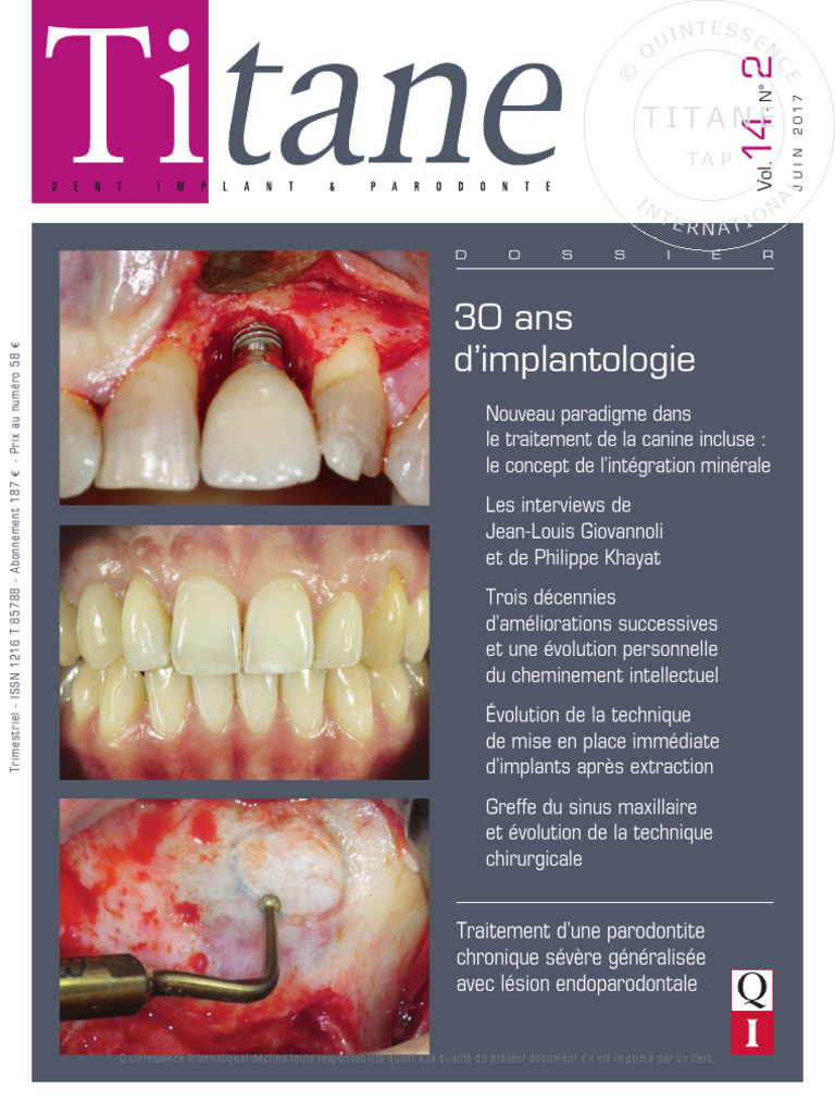 Nouveau traitement pour canines incluses | PDF | Implant dentaire ...