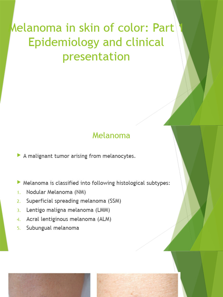 Understanding Melanoma Why Blanching Matters And When It Doesn T - en0k7mv