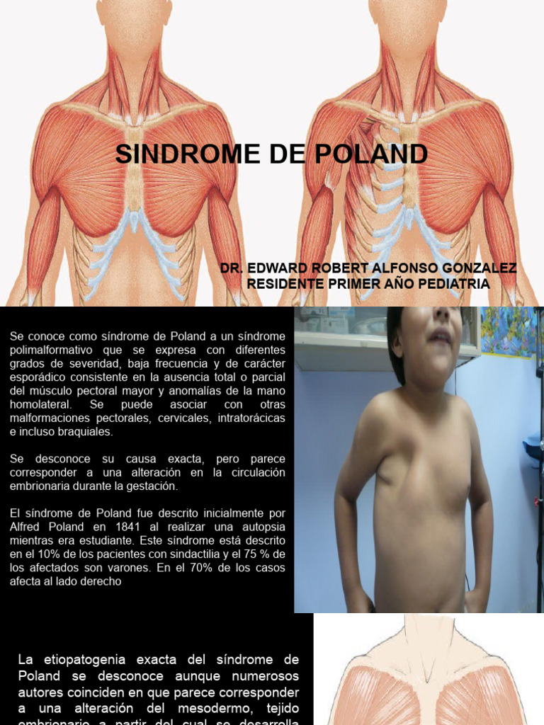 sindrome-poland-edward-pdf-medicina-clinica-enfermedades-y-trastornos