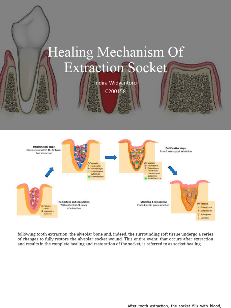 Socket Healing After Tooth Extraction | PDF | Bone | Coagulation