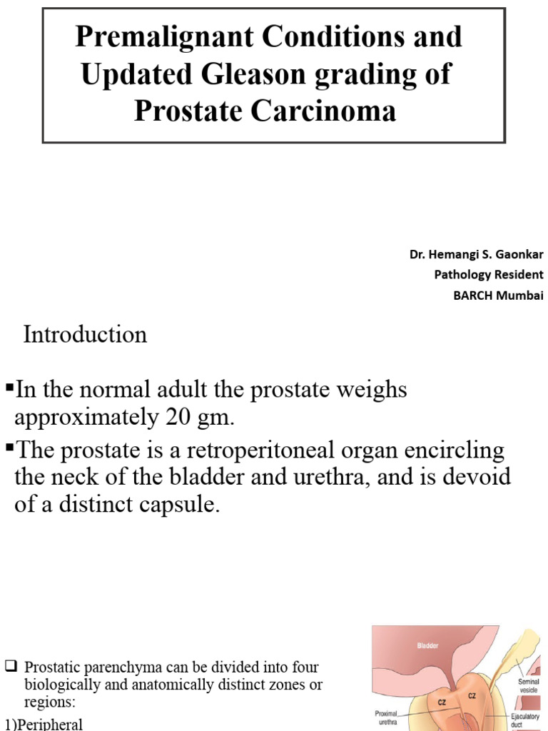 Prostate Carcinoma: Gleason Grading Guide | PDF | Prostate | Prostate ...