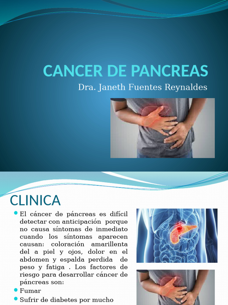 cancer-de-pancreas-pdf-c-ncer-c-ncer-de-p-ncreas
