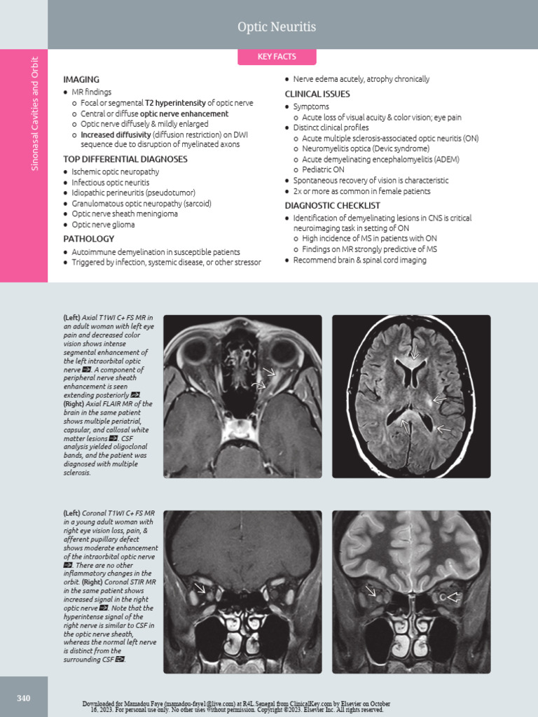 Optic Neuritis | PDF