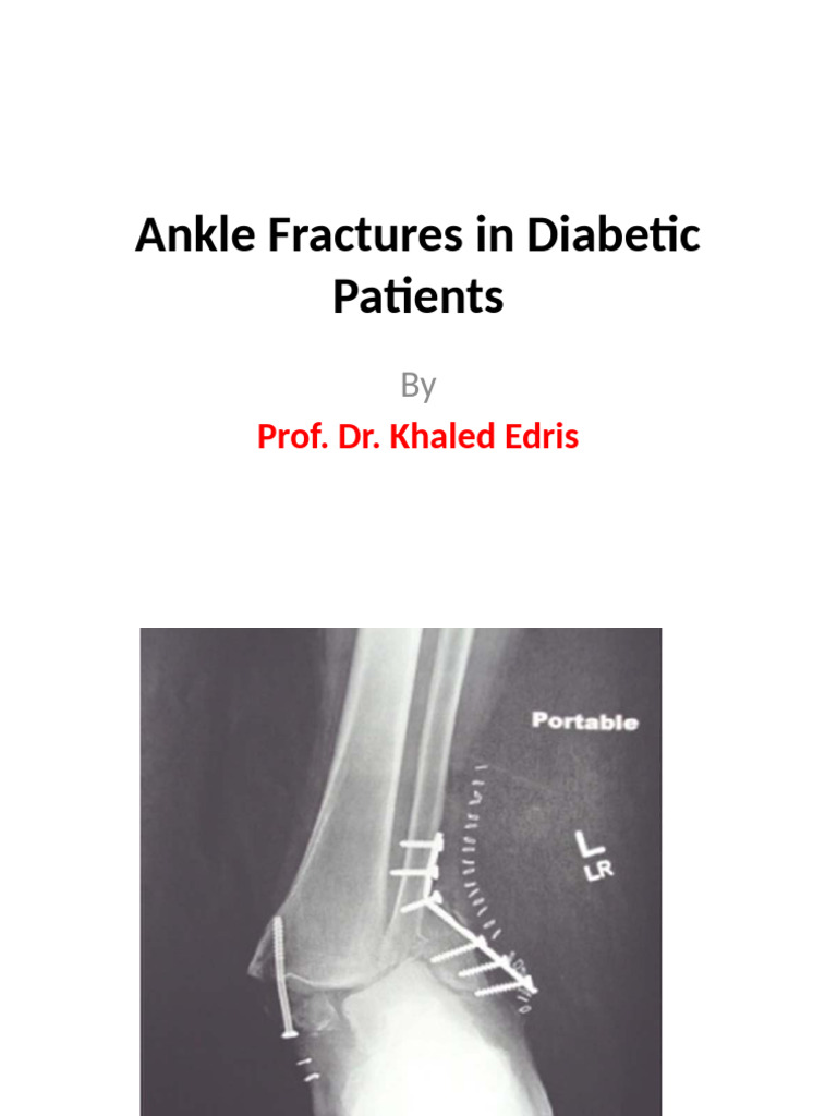 Managing Diabetic Ankle Fractures | PDF | Diabetes | Wound