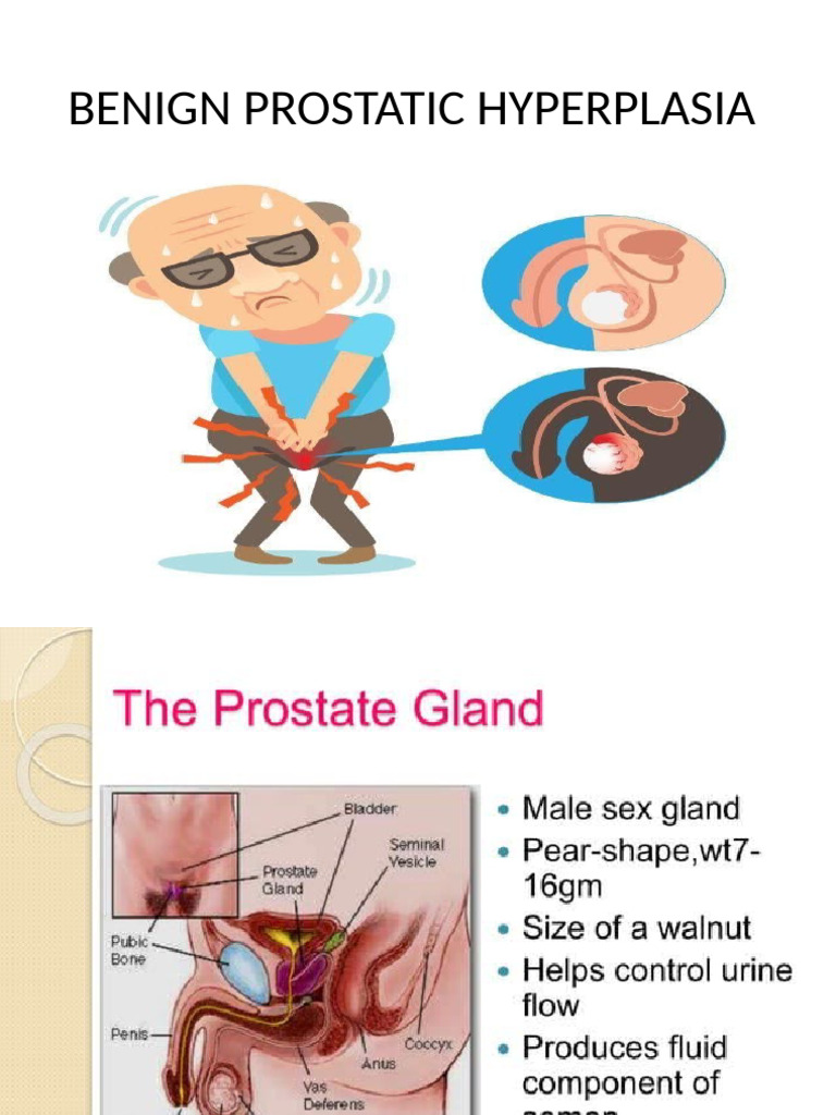 英語での Benign Prostatic Hyperplasia の意味 – QPEEBK