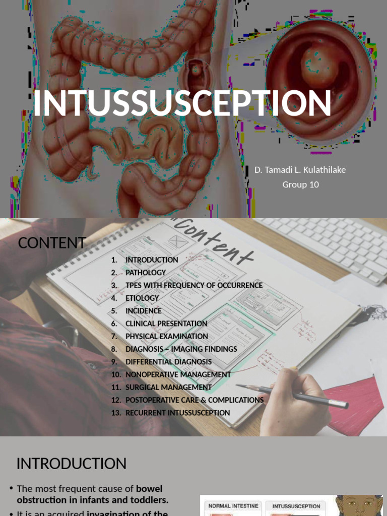 Intussusception Compressed | PDF