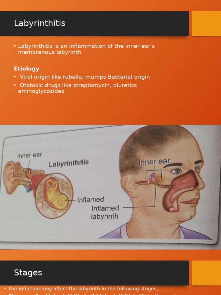 Labyrinthitis | PDF