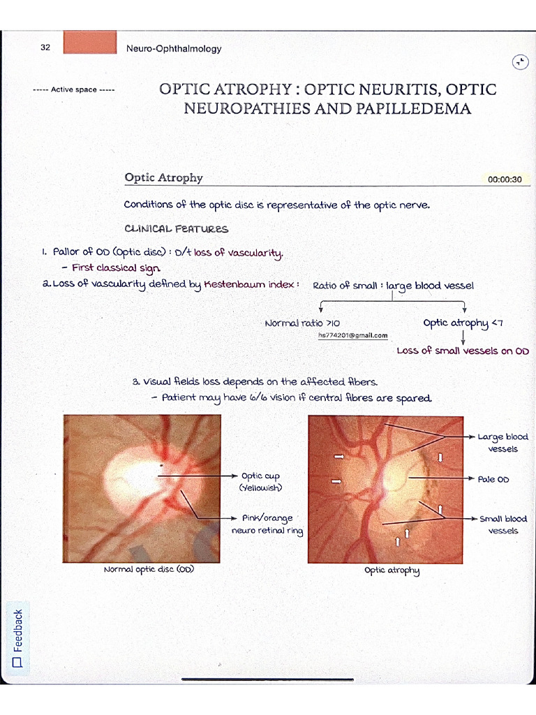 Optic Atropy | PDF