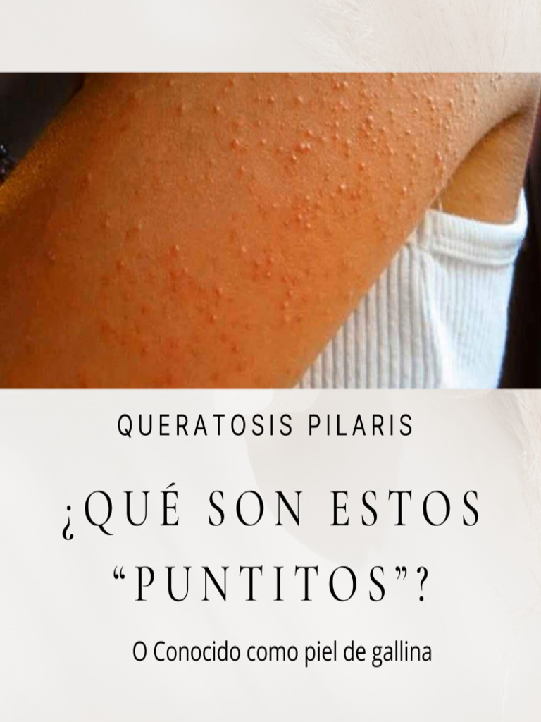 Queratosis Pilaris | PDF