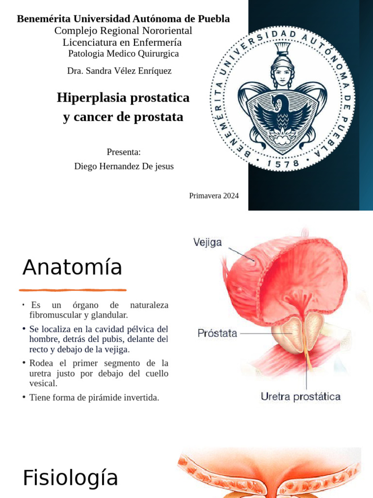Hiperplasia Prostatica y Cancer de Prostata | PDF
