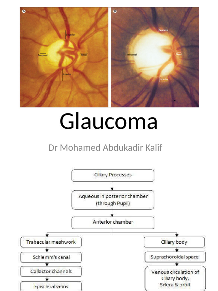Glaucoma (POAG and PACG) | PDF