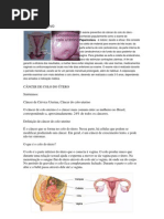 Cancer de Ultero