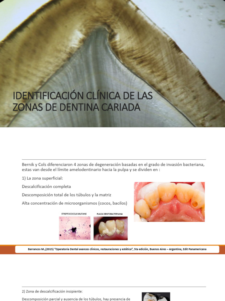 3.identificación Clínica de Las Zonas de Dentina Cariada. | PDF