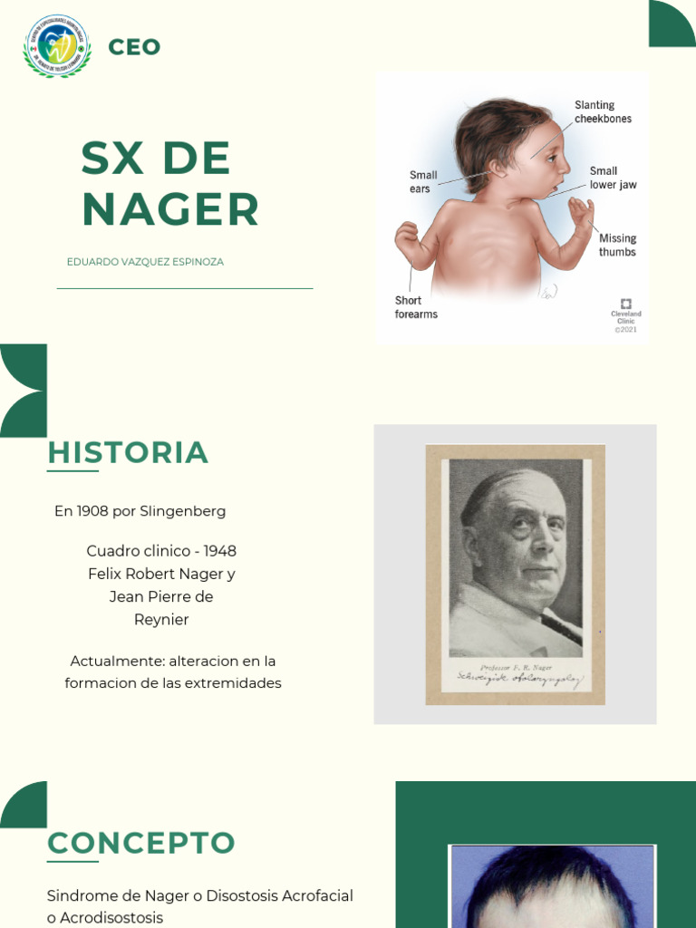 Sindrome de Nager | PDF