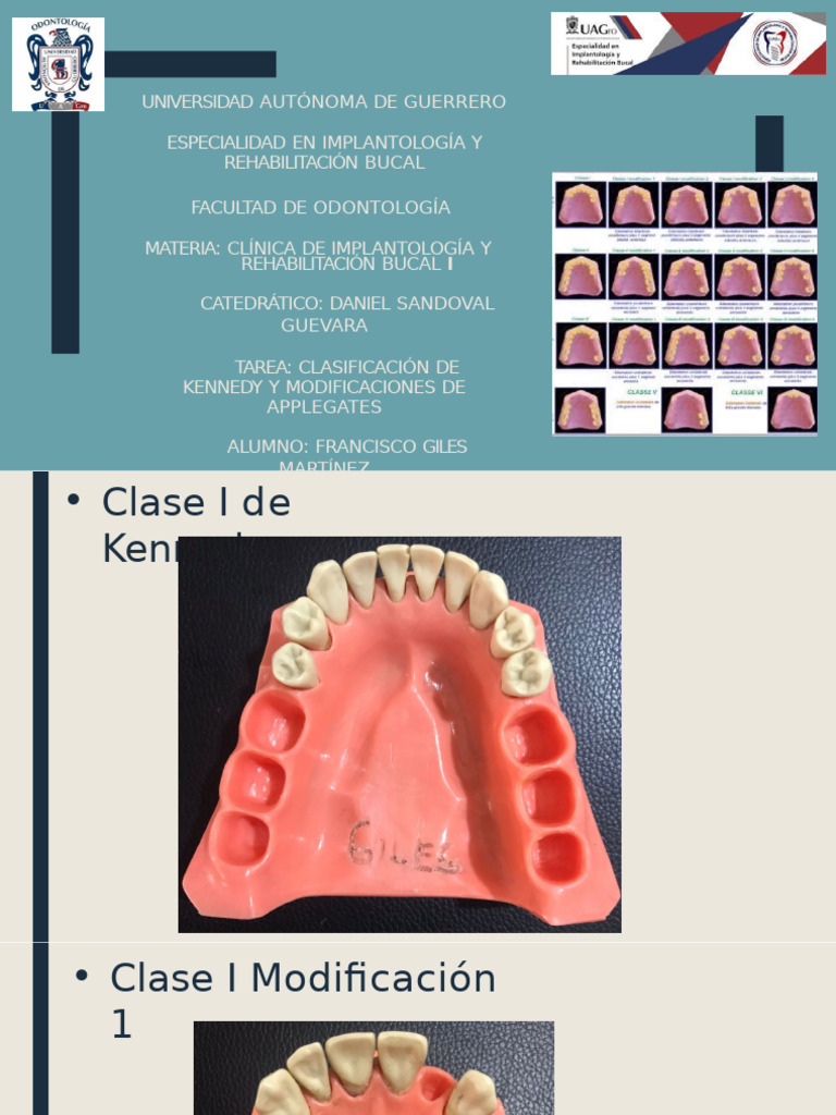 Clasificación y Modificaciones de Kennedy | PDF