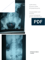 LK/RK Kidney PS Psoas Outline PP Properitoneal Fat Empty Bladder (Cant Visualise) Arrow Rectosigmoid Junction Distended W Gas